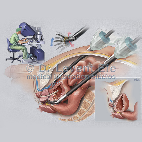 Medical Illustration: Robotic Surgery of the Prostate, Surgical Art,  Surgical Illustrations | Dr. Efe's Medical Art Store: Medical Illustrations  and Surgical Art