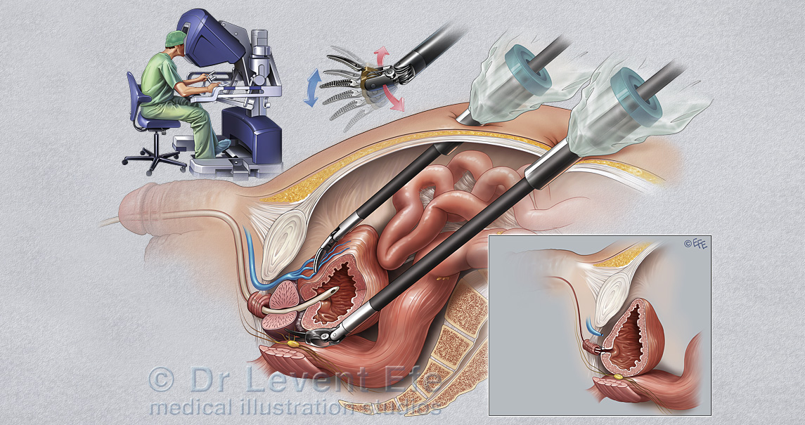 Robotic surgery of prostate