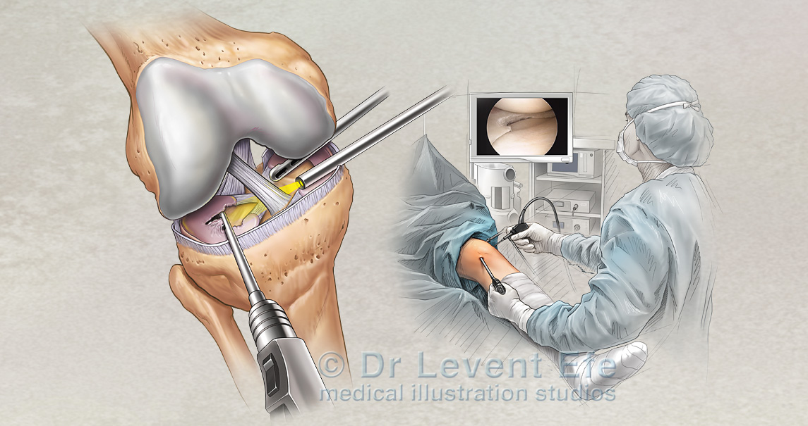 knee arthroscopy and meniscus repair