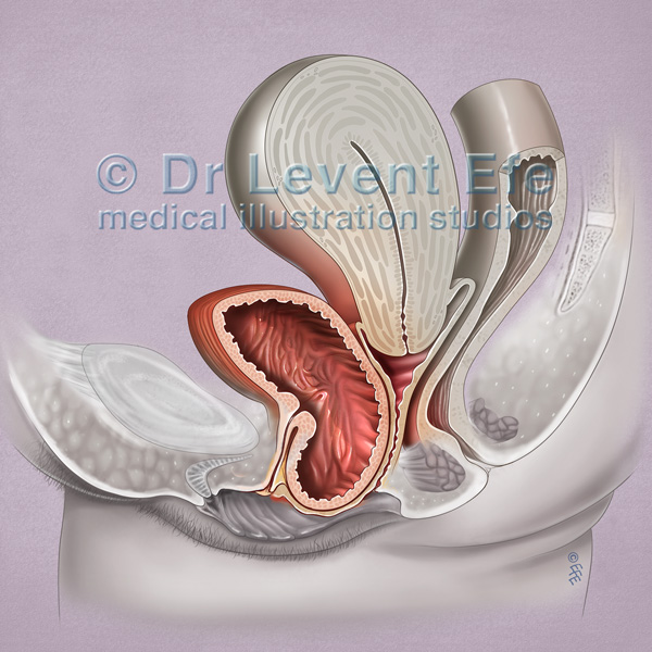 A Cystocele is Also Known As a Bladder Prolapse, a Fallen Bladder, a Prolapsed  Bladder, or an Anterior Vaginal Prolapse Stock Illustration - Illustration  of childbirth, ovary: 272801017