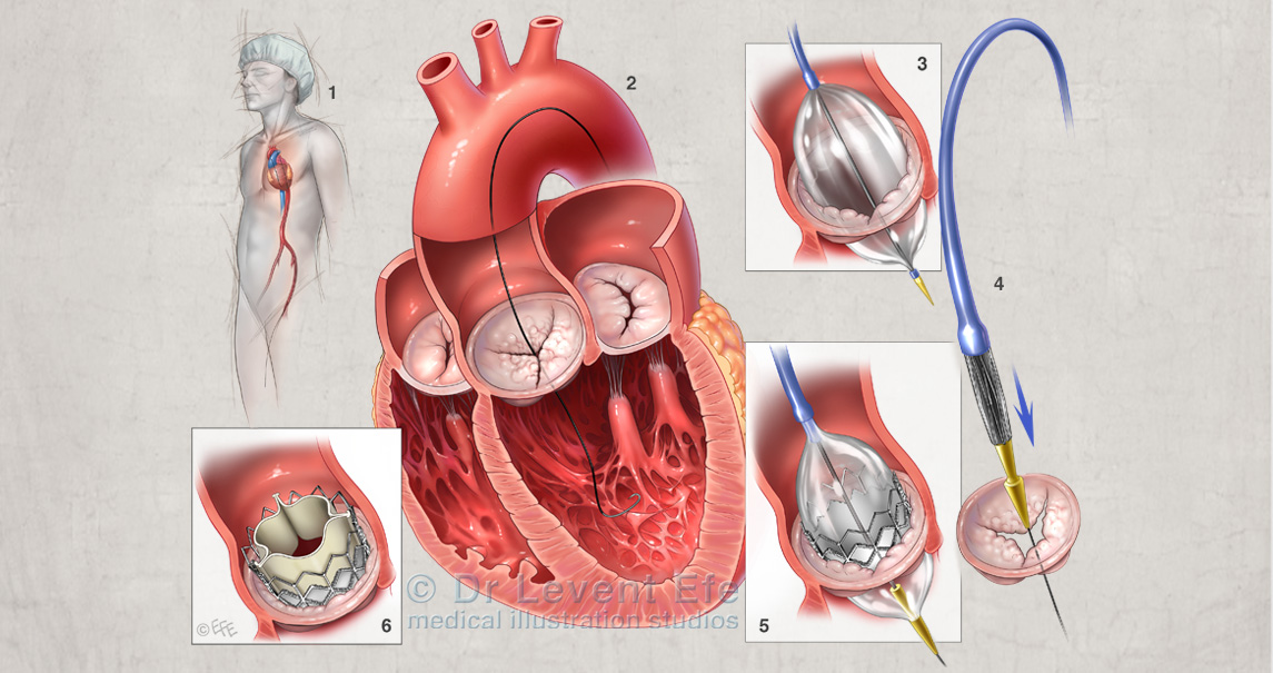Transcatheter aortic valve insertion